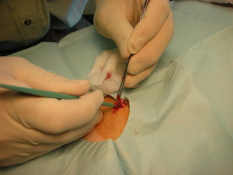 Excision of sebaceous cyst