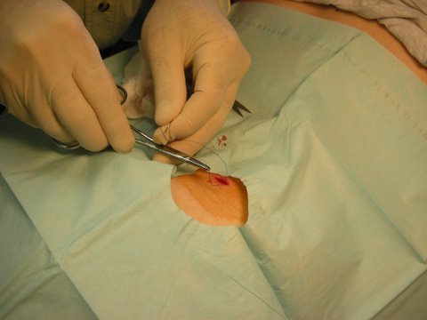Wound closure with simple sutures