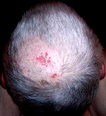 shingles-on-scalp